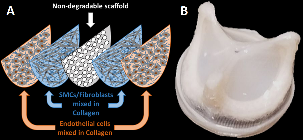 How Long Does A Tissue Valve Replacement Last